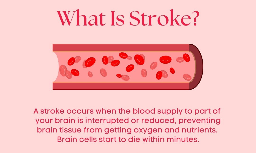 Stroke: Causes, Symptoms, and Treatment